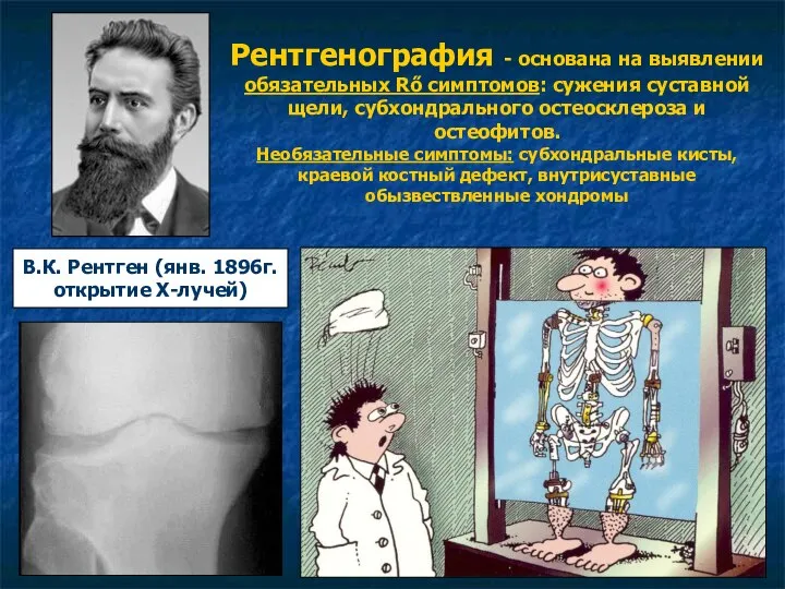 Рентгенография - основана на выявлении обязательных Rő симптомов: сужения суставной щели, субхондрального