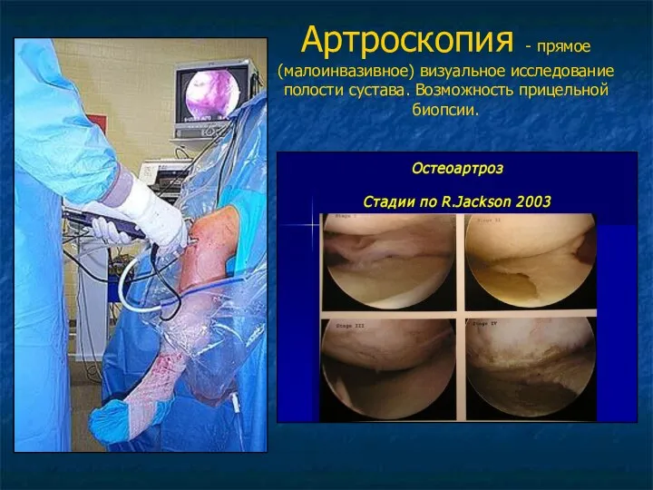 Артроскопия - прямое (малоинвазивное) визуальное исследование полости сустава. Возможность прицельной биопсии.