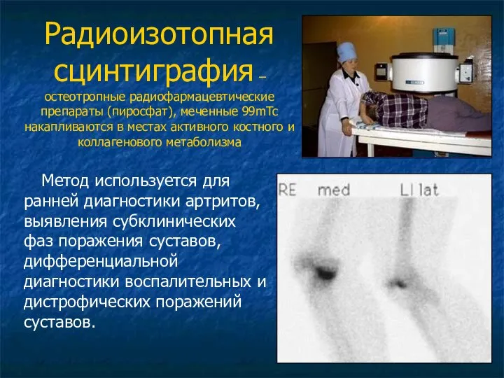 Радиоизотопная сцинтиграфия – остеотропные радиофармацевтические препараты (пиросфат), меченные 99mTc накапливаются в местах