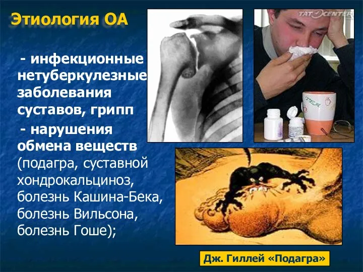 Этиология ОА - инфекционные нетуберкулезные заболевания суставов, грипп - нарушения обмена веществ