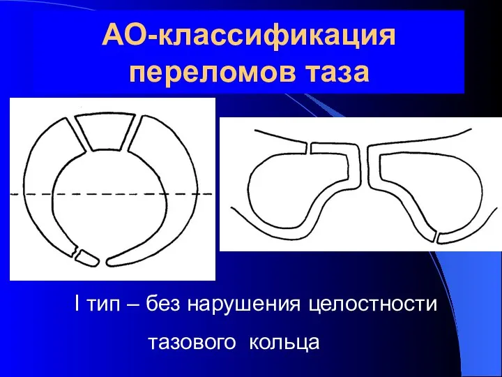 АО-классификация переломов таза I тип – без нарушения целостности тазового кольца