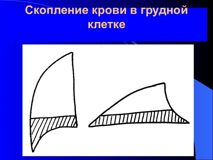 Скопление крови в грудной клетке