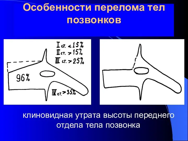 Особенности перелома тел позвонков клиновидная утрата высоты переднего отдела тела позвонка