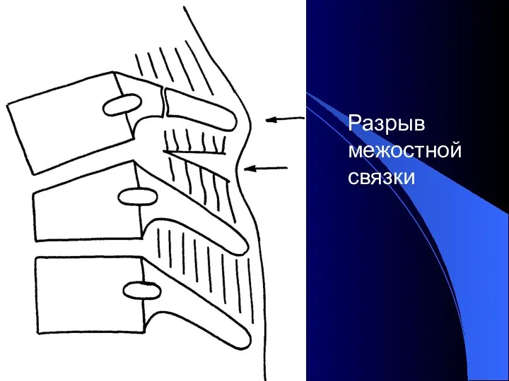 Разрыв межостной связки