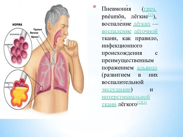 Пневмони́я (греч. pnéumōn, лёгкие[1]), воспале́ние лёгких — воспаление лёгочной ткани, как правило,