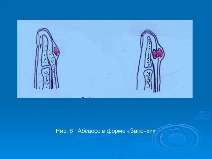 Рис. 6 Абсцесс в форме «Запонки»