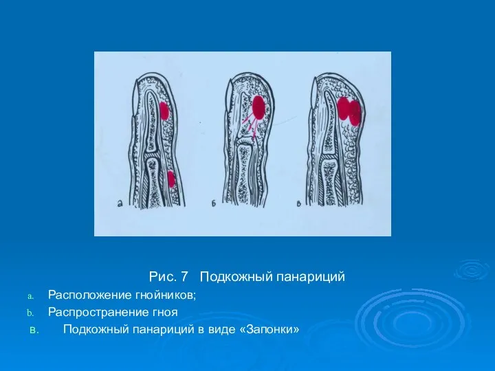 Рис. 7 Подкожный панариций Расположение гнойников; Распространение гноя в. Подкожный панариций в виде «Запонки»