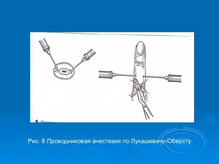 Рис. 8 Проводниковая анестезия по Лукашевичу-Оберсту