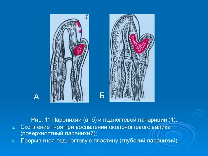 Рис. 11 Паронихии (а, б) и подногтевой панариций (1). Скопление гноя при