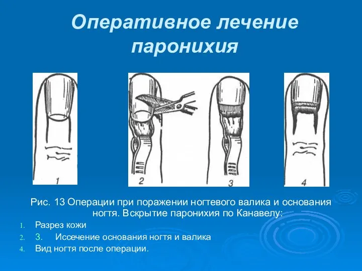 Рис. 13 Операции при поражении ногтевого валика и основания ногтя. Вскрытие паронихия