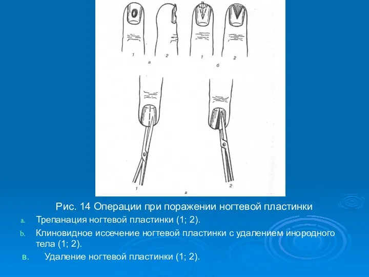 Рис. 14 Операции при поражении ногтевой пластинки Трепанация ногтевой пластинки (1; 2).