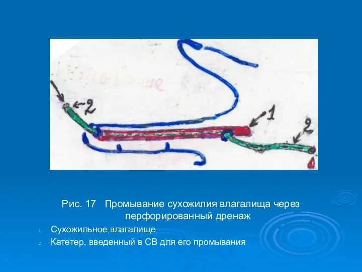 Рис. 17 Промывание сухожилия влагалища через перфорированный дренаж Сухожильное влагалище Катетер, введенный