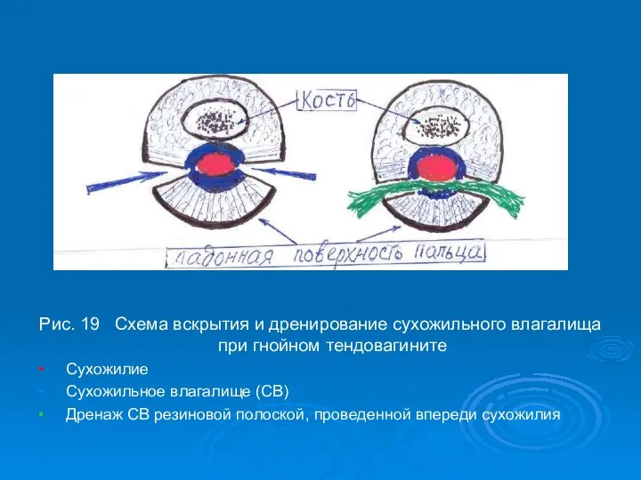 Рис. 19 Схема вскрытия и дренирование сухожильного влагалища при гнойном тендовагините •