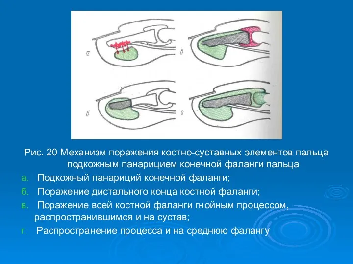 Рис. 20 Механизм поражения костно-суставных элементов пальца подкожным панарицием конечной фаланги пальца