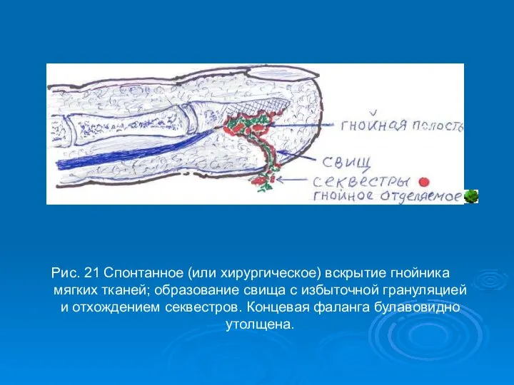 Рис. 21 Спонтанное (или хирургическое) вскрытие гнойника мягких тканей; образование свища с