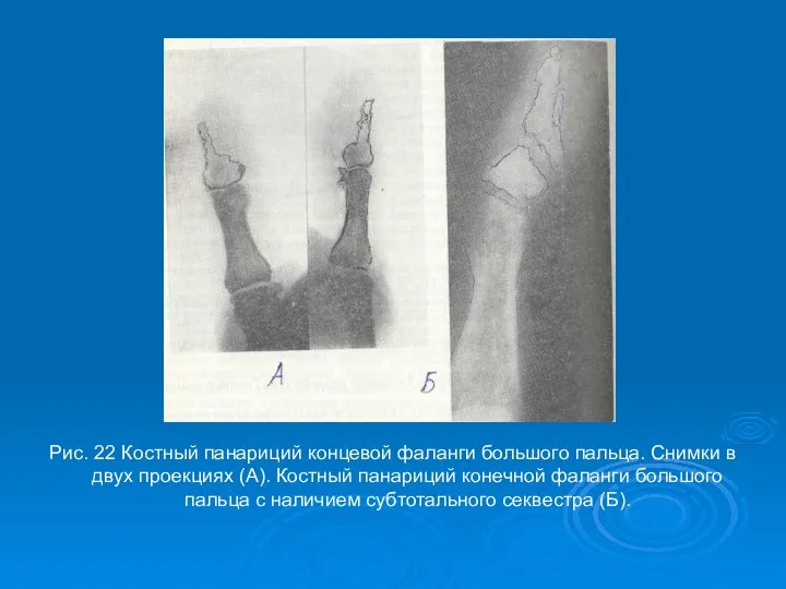 Рис. 22 Костный панариций концевой фаланги большого пальца. Снимки в двух проекциях