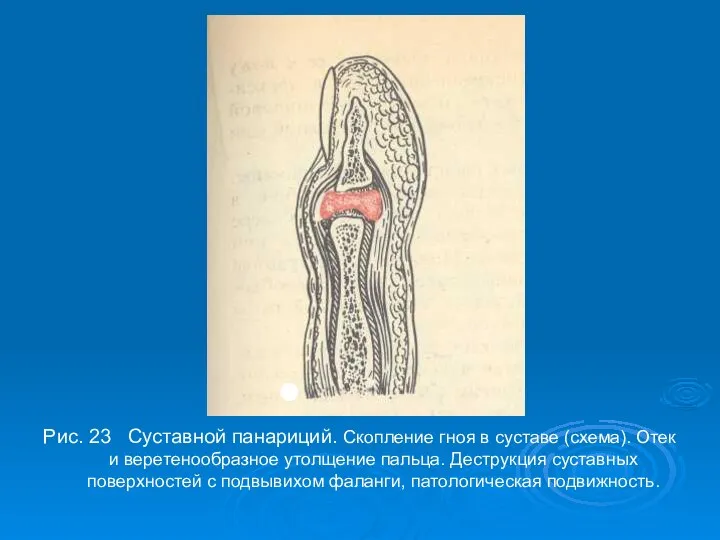 Рис. 23 Суставной панариций. Скопление гноя в суставе (схема). Отек и веретенообразное