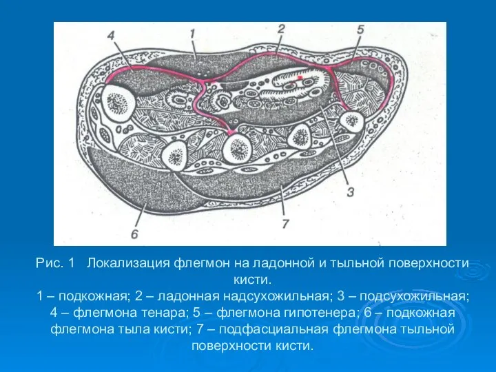 Рис. 1 Локализация флегмон на ладонной и тыльной поверхности кисти. 1 –