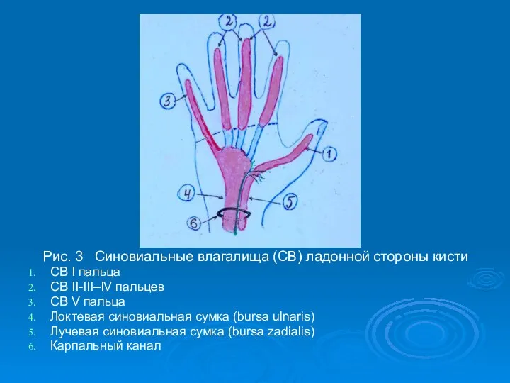 Рис. 3 Синовиальные влагалища (СВ) ладонной стороны кисти СВ I пальца СВ