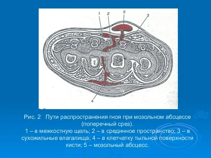 Рис. 2 Пути распространения гноя при мозольном абсцессе (поперечный срез). 1 –