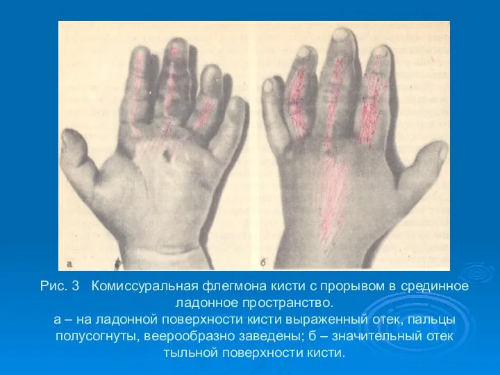 Рис. 3 Комиссуральная флегмона кисти с прорывом в срединное ладонное пространство. а