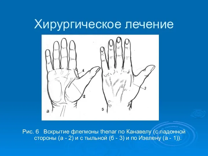 Хирургическое лечение Рис. 6 Вскрытие флегмоны thenar по Канавелу (с ладонной стороны