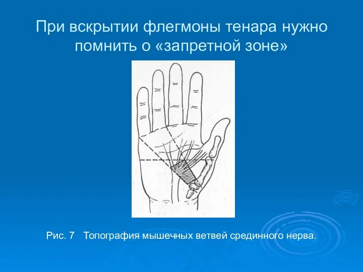 При вскрытии флегмоны тенара нужно помнить о «запретной зоне» Рис. 7 Топография мышечных ветвей срединного нерва.