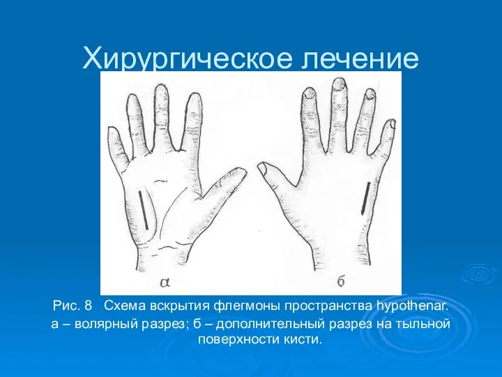 Хирургическое лечение Рис. 8 Схема вскрытия флегмоны пространства hypothenar. а – волярный