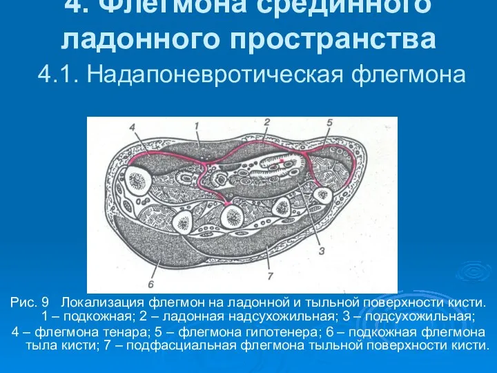 4. Флегмона срединного ладонного пространства 4.1. Надапоневротическая флегмона Рис. 9 Локализация флегмон