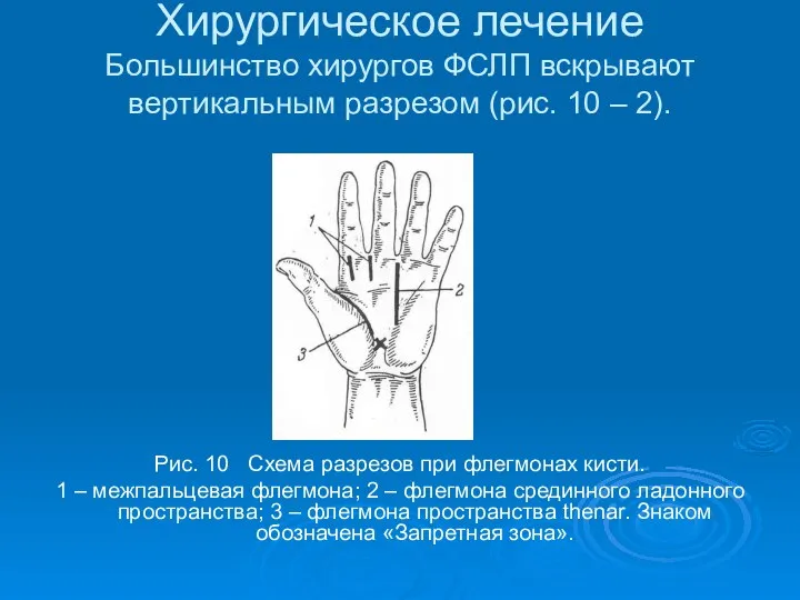 Хирургическое лечение Большинство хирургов ФСЛП вскрывают вертикальным разрезом (рис. 10 – 2).