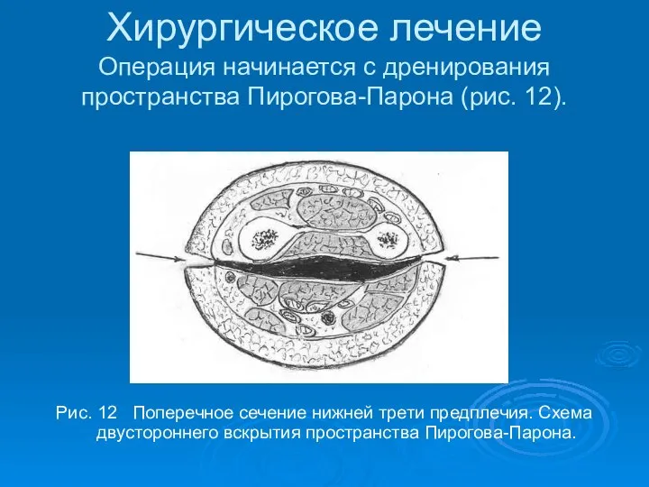 Хирургическое лечение Операция начинается с дренирования пространства Пирогова-Парона (рис. 12). Рис. 12