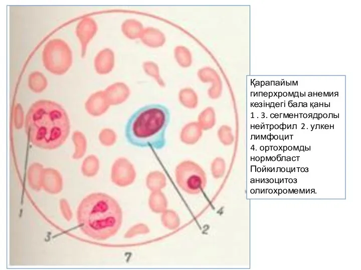 Қарапайым гиперхромды анемия кезіндегі бала қаны 1 . 3. сегментоядролы нейтрофил 2.