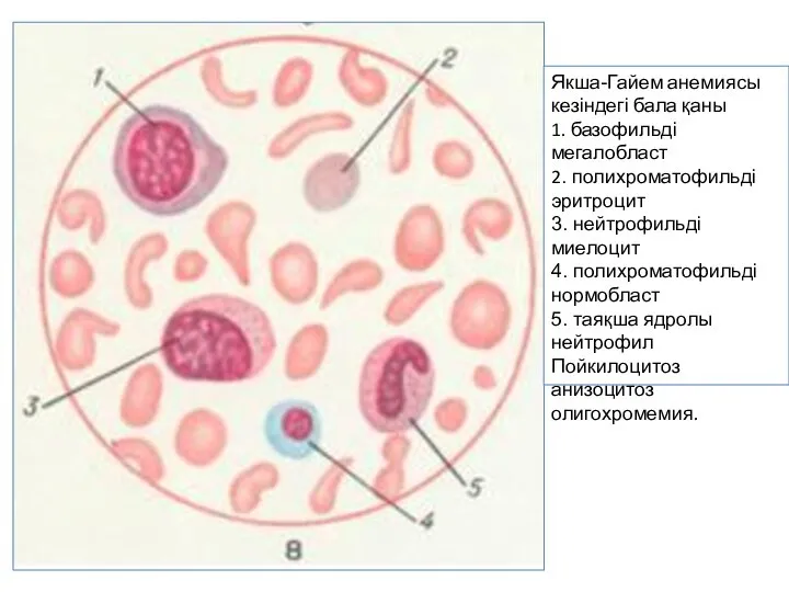 Якша-Гайем анемиясы кезіндегі бала қаны 1. базофильді мегалобласт 2. полихроматофильді эритроцит 3.