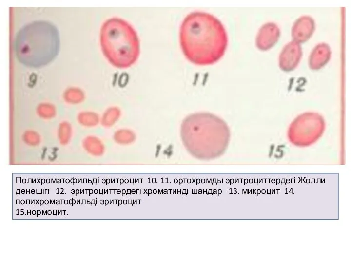Полихроматофильді эритроцит 10. 11. ортохромды эритроциттердегі Жолли денешігі 12. эритроциттердегі хроматинді шаңдар