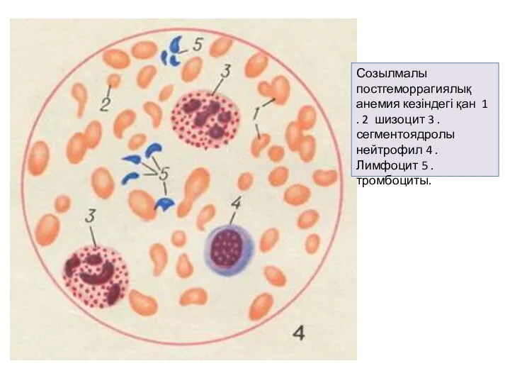 Созылмалы постгеморрагиялық анемия кезіндегі қан 1 . 2 шизоцит 3 . сегментоядролы