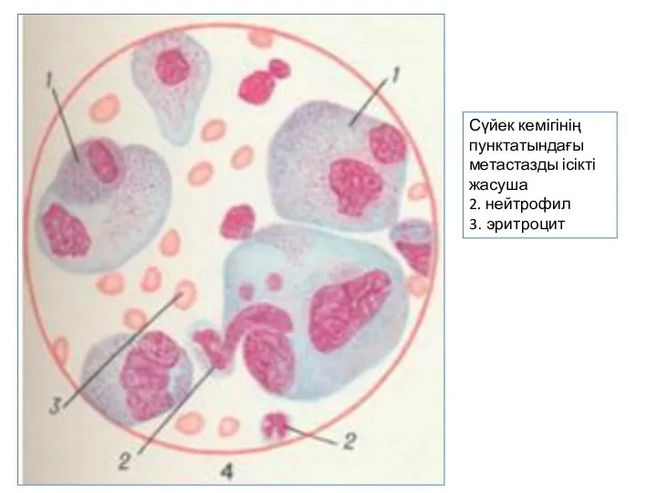 Сүйек кемігінің пунктатындағы метастазды ісікті жасуша 2. нейтрофил 3. эритроцит