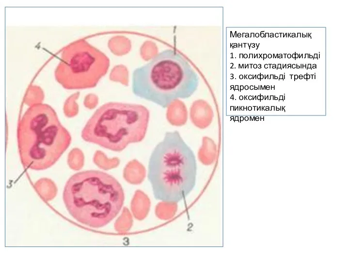 Мегалобластикалық қантүзу 1. полихроматофильді 2. митоз стадиясында 3. оксифильді трефті ядросымен 4. оксифильді пикнотикалық ядромен