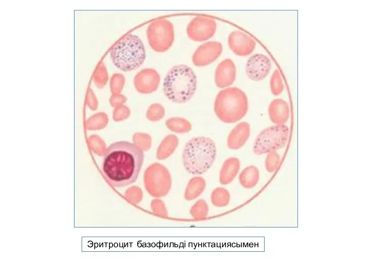 Эритроцит базофильді пунктациясымен