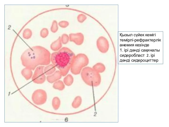 Қызыл сүйек кемігі темірлі-рефрактерлік анемия кезінде 1. ірі дәнді сақиналы сидеробласт 2. ірі дәнді сидероциттер