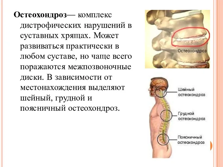 Остеохондроз— комплекс дистрофических нарушений в суставных хрящах. Может развиваться практически в любом