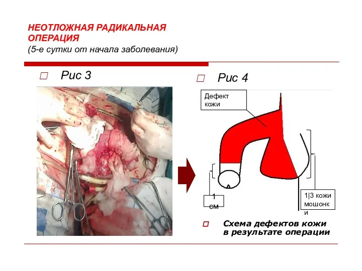НЕОТЛОЖНАЯ РАДИКАЛЬНАЯ ОПЕРАЦИЯ (5-е сутки от начала заболевания) Рис 4 Рис 3