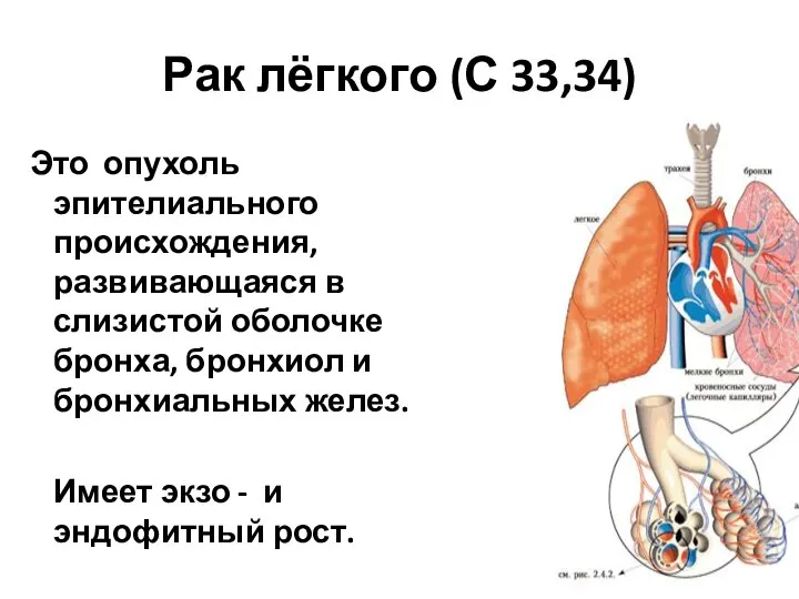 Рак лёгкого (С 33,34) Это опухоль эпителиального происхождения, развивающаяся в слизистой оболочке