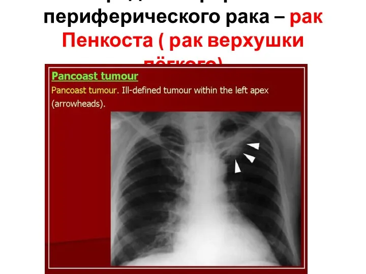 редкая форма периферического рака – рак Пенкоста ( рак верхушки лёгкого)