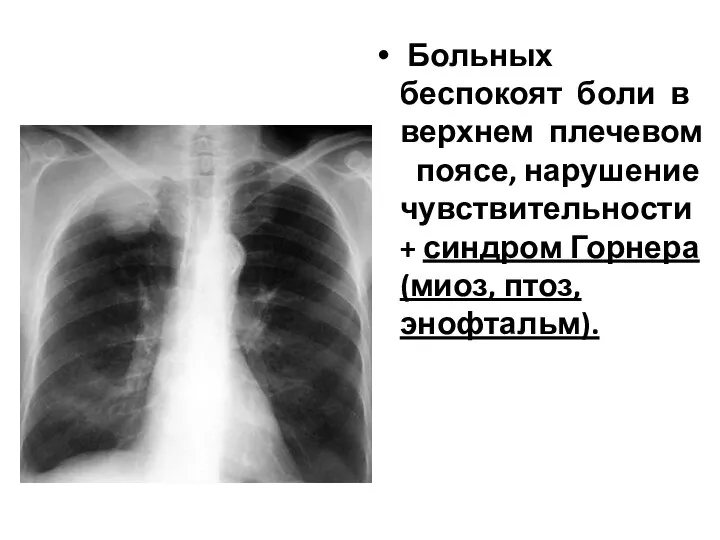 Больных беспокоят боли в верхнем плечевом поясе, нарушение чувствительности + синдром Горнера (миоз, птоз, энофтальм).