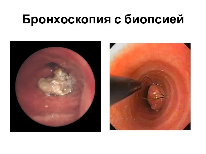 Бронхоскопия с биопсией