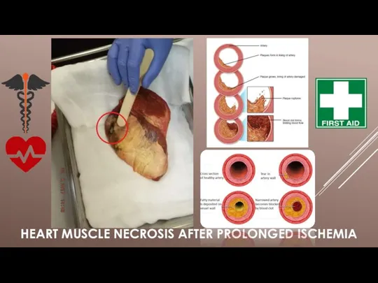 HEART MUSCLE NECROSIS AFTER PROLONGED ISCHEMIA