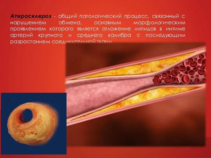 Атеросклероз - общий патологический процесс, связанный с нарушением обмена, основным морфологическим проявлением