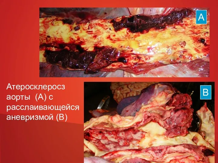 Атеросклеросз аорты (А) с расслаивающейся аневризмой (В) А В