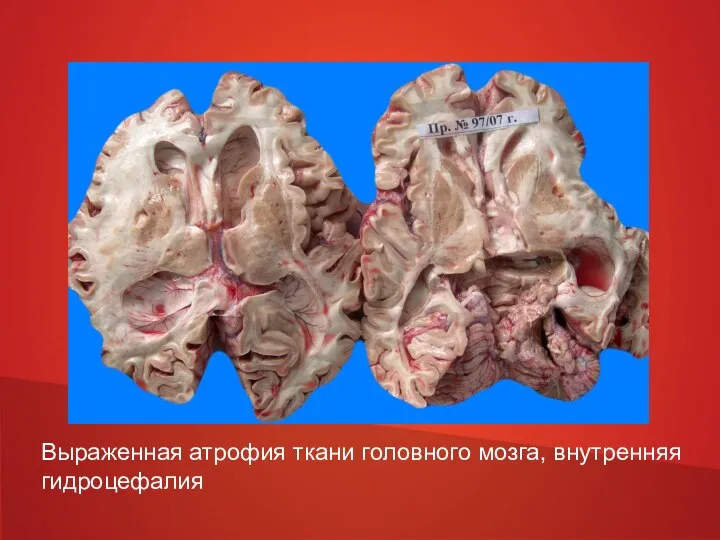 Выраженная атрофия ткани головного мозга, внутренняя гидроцефалия