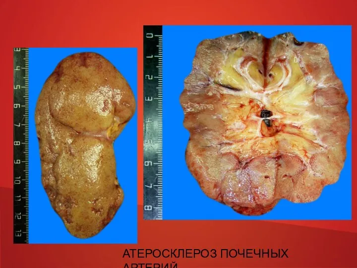 АТЕРОСКЛЕРОЗ ПОЧЕЧНЫХ АРТЕРИЙ